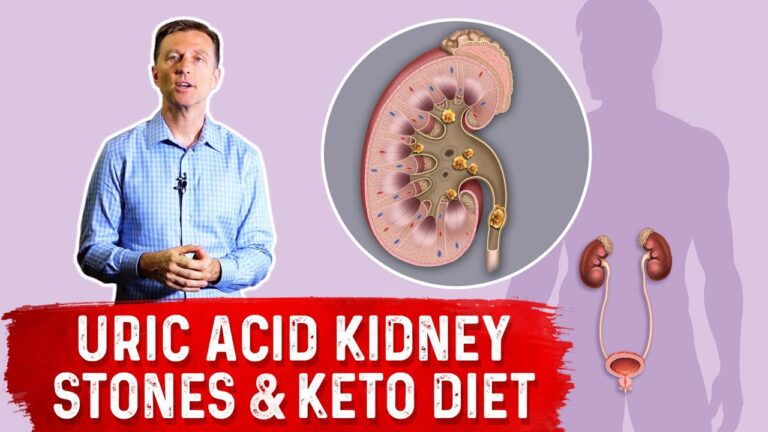 Uric Acid Kidney Stones & Keto Diet – Dr. Berg